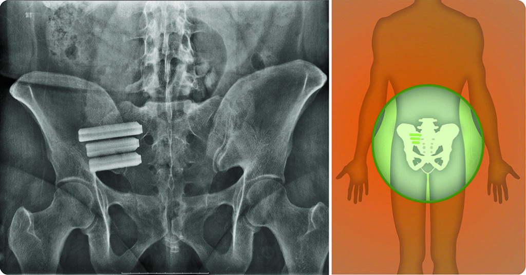 Back Pain after Baby? Could be your SI Bone